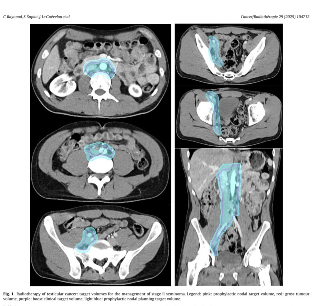 PaulSargos's tweet image. ⚡Guidelines Alert: 
        
🔗Management of testis cancer for #radoncs

✨Out now

👏 @CharlesRaynaud
@PBlanchardMD
@JennKa12
@stephanesupiot
@maximilienroge
@RoubaudG
@SFjROfr

sciencedirect.com/science/articl…