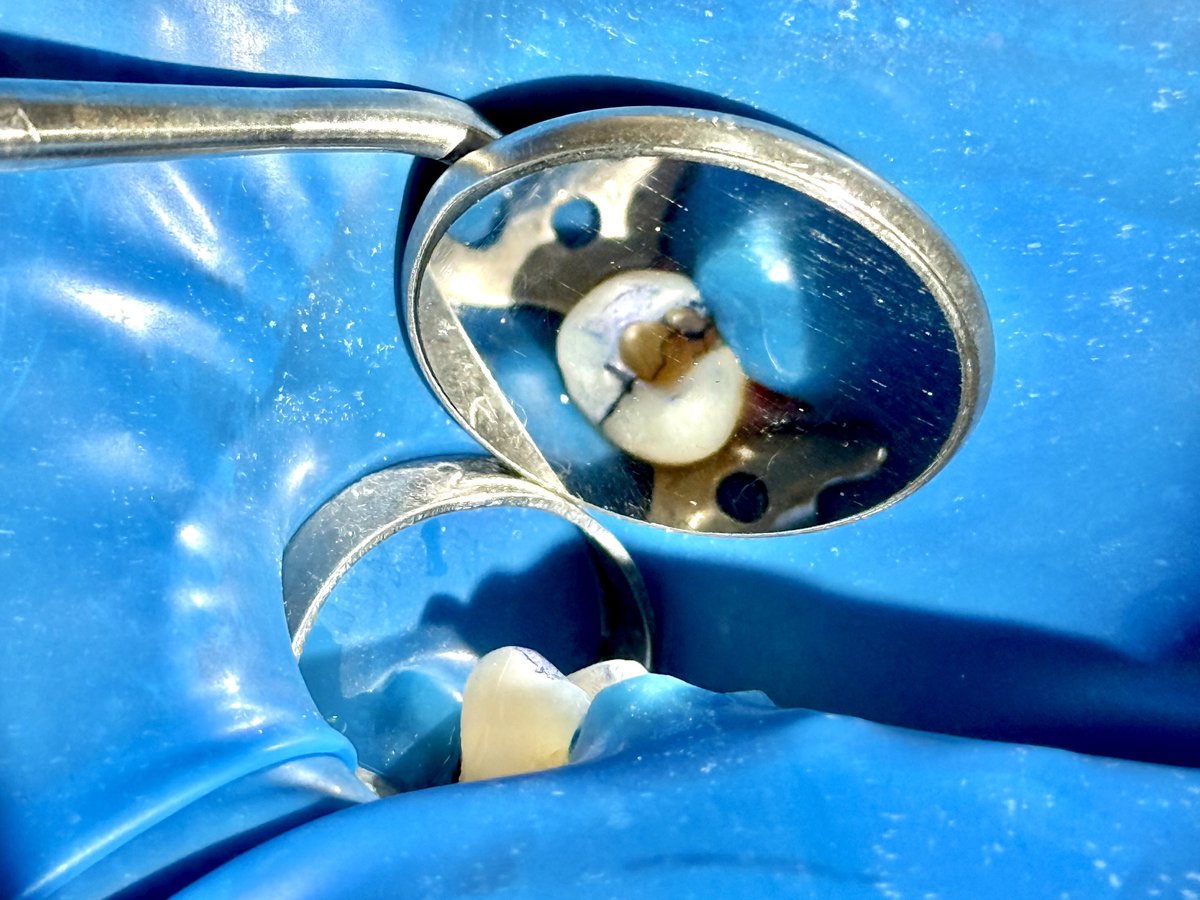 Interesting case 🦷
Patient referred from the PHC for RCT of Tooth#25 
Cold test:negative 
EPT:negative 
Bite test:pain to buccal cusp
Percussion:tender 
Probing:more than10mm in(MB,DB area)
Two sinus tract
Open the tooth and stain with methylene blue and located very deep crack