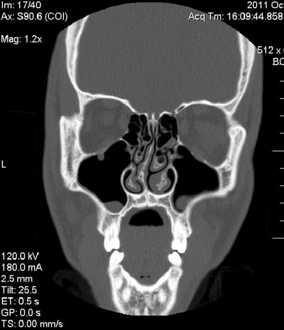 nanoWorldx's tweet photo. "Sinus infections, snoring & sleep issues are often tied to a #DeviatedSeptum. Experts warn: early diagnosis isn’t just about breathing better it helps prevent long-term risks like sinus pain & sleep apnea. #Health #Wellness #SinusInfection #ENT" https://t.co/b6gT1ifDDp
