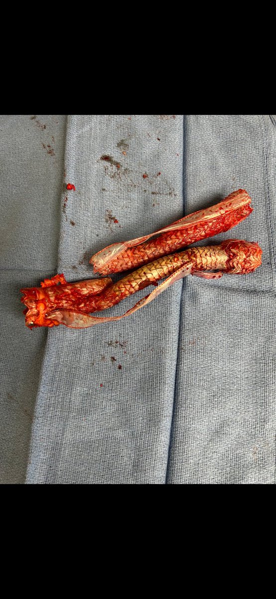 canuc_57's tweet photo. Another one bites the dust, another  EVAR placed outside IFU, now it’s #inthebucket ! When will surgeons learn the IFU is there for a reason?@MaherSabalbal @peterjrossi @farkomd @DrPatGeraghty @westleyohman @FLareyre @AWBeckMD @VascularSVS @CanadianSVS https://t.co/h0qQz0NapE