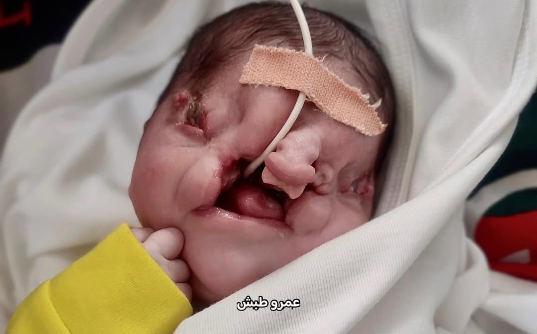 EyeonPalestine's tweet photo. Infant Hikmah Noufal (21 days old) was born with severe and complex facial deformities, after her mother was exposed during the war to toxic gases, the smell of gunpowder and missiles, as well as contaminated and unhealthy food and water.
Doctors in Gaza stand helpless before her rare condition.
They lack the ability to diagnose her precisely or perform any surgical intervention, amid the collapse of the health system and the absence of resources.
Today, infant Hikmah struggles in silence, but she is in urgent need of complex surgeries and long-term treatment abroad.
Every moment of delay could cost her life.
Save this innocent soul... Save infant Hikmah who is still breathing amidst the rubble and devastation.
Contact: 00972599014905

الرضيعة حكمة نوفل (21 يومًا) ولدت بتشوهات خلقية قاسية ومعقدة في وجهها، بعدما تعرضت والدتها أثناء الحرب للغازات السامة ورائحة البارود
والصواريخ، إضافة إلى الطعام والمياه الملوثة.
الأطباء في غزة يقفون عاجزين أمام حالتها النادرة، فلا يملكون القدرة على تشخيصها بدقة أو إجراء أي تدخل جراحي، في ظل انهيار المنظومة الصحية
وانعدام الإمكانيات.
اليوم، حكمة الصغيرة تقاوم بصمت، لكنها بحاجة إلى عمليات جراحية معقدة وعلاج طويل بالخارج، وكل لحظة تأخير قد تسلبها حياتها.
أنقذوا هذه الروح البريفة... أنقذوا الطفلة التي ما زالتكام والخرابا