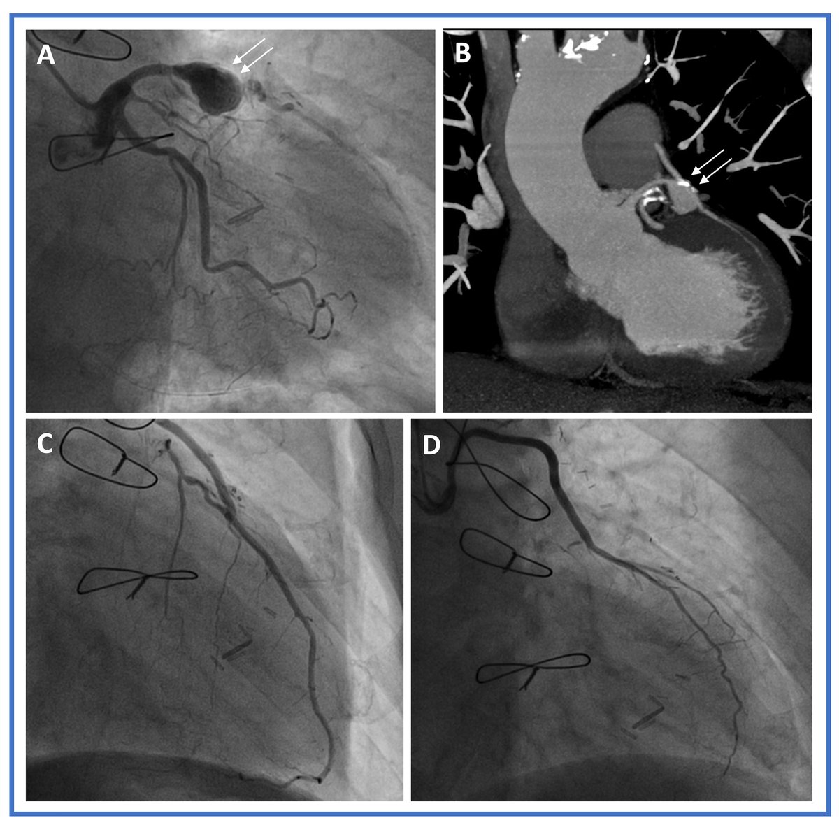Vessel_Plus's tweet image. ✨ Aneurysmal Coronary Artery Disease
🔍 Diagnosis by size, morphology, vessels, etiology
🛠 #PCI &amp;amp; surgery face stent and thrombus challenges
⏱ Medical therapy remains key in high-risk cases
#CoronaryAneurysm #InterventionalCardiology #CardioImaging

🔗 oaepublish.com/articles/2574-…