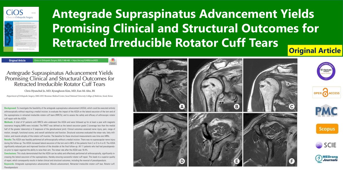 CiOSjournal's tweet image. Antegrade Supraspinatus Advancement Yields Promising Clinical and Structural Outcomes for Retracted Irreducible Rotator Cuff Tears
🌷doi.org/10.4055/cios24…
2025 Jun;17(3) Chris Hyunchul Jo
#Antegrade_supraspinatus_advancement #Muscle_advancement #Rotator_cuff #Pseudoparalysis