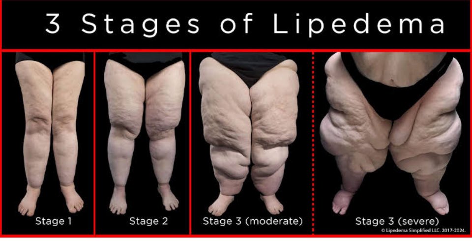 Joey King (@joey_kinginwa) on Twitter photo Lipedema is a chronic disease with no cure. Without intervention, this can happen…
chuffed.org/project/kb6v-h…
<a href="/Mark_Butler_MP/">Mark Butler MP</a> Lipedema is a chronic disease with no cure. Without intervention, this can happen…
chuffed.org/project/kb6v-h…
<a href="/Mark_Butler_MP/">Mark Butler MP</a>