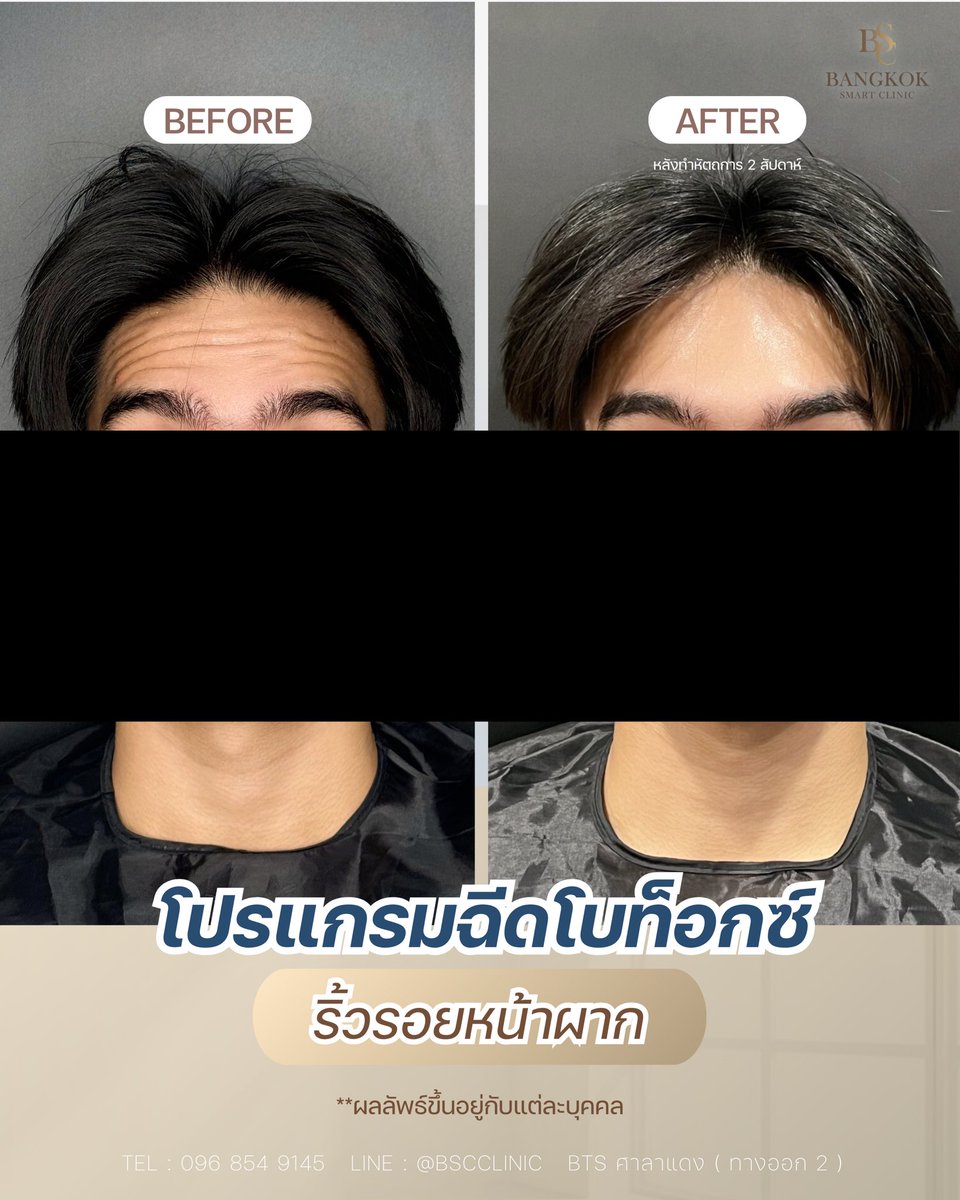 BSCClinic's tweet photo. ✨ รีวิว Program Botulinum Toxin ลดรอยหน้าผาก ✨

ก่อนทำ ➡️ มีรอยชัดเวลายกคิ้ว ทำให้ดูมีอายุและไม่มั่น���จ
หลังทำ 2 สัปดาห์ ➡️ รอยดูเรียบขึ้น หน้าผากดูสวยเนียน เวลายิ้มยกคิ้วก็ดูเป็นธรรมชาติมากขึ้น 💙

คุณหมอโค้ช
นพ.ธนาวัต แหวนวงษ์
ว.47364 https://t.co/Cja2dHN7Ww