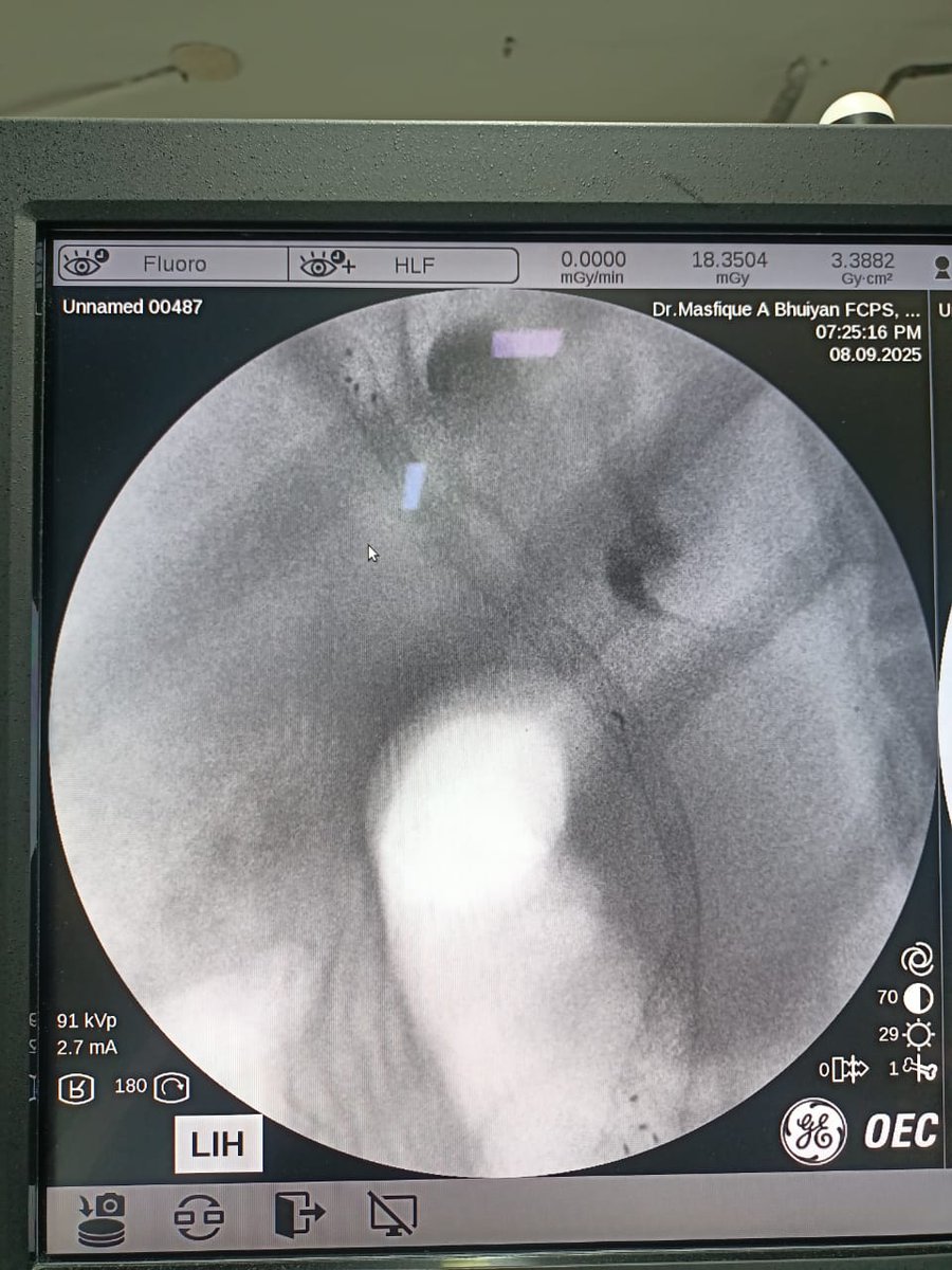 endoscopy_unit's tweet photo. ERCP SEMS Deployment in Klatskin (Cholangiocarcinoma) tumour.
Dr. Masfique Ahmed Bhuiyan https://t.co/pz60DUBqXE