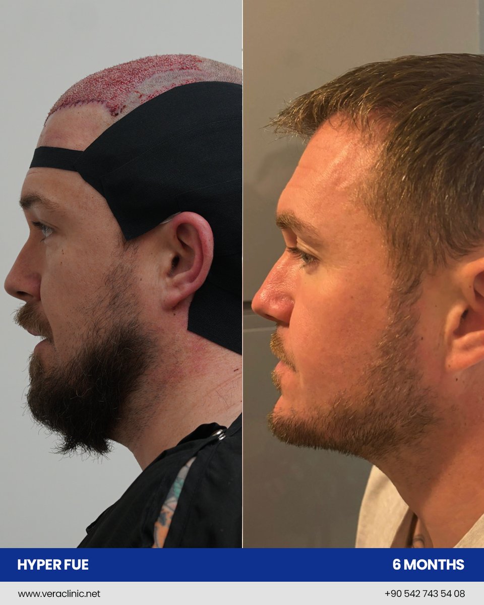 6 months into his Hyper FUE journey at Vera Clinic, the transformation is taking shape!
Subtle progress today, regained confidence tomorrow.

📍 Vera Clinic | Stress-free hair transplant experience trusted worldwide.
✨ Ready to start your journey? Book your free consultation