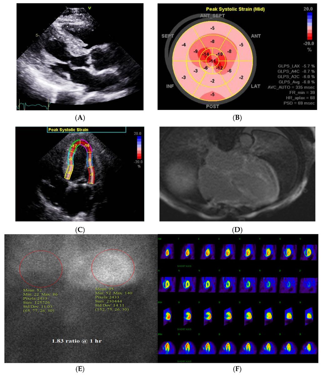 LabMedMDPI's tweet image. #HighlyAccessedPaper
#Amyloidosis
"Monoclonal Protein Evaluation in the Diagnostic Algorithm for Cardiac Amyloidosis" 
by Syed Bukhari
👉Check out the full paper at mdpi.com/2813-9038/2/3/…
