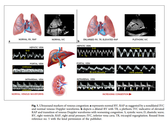 NephroKarger's tweet photo. Unlocking the Potential of #VExUS in Assessing Venous Congestion: The Art of Doing It Right
🔗https://t.co/dFGVXK5zJM
✍ Koratala A. et al. 
📖#CardiorenalMed
#Nephrology #HeartFailure https://t.co/YJY3OAPZUC