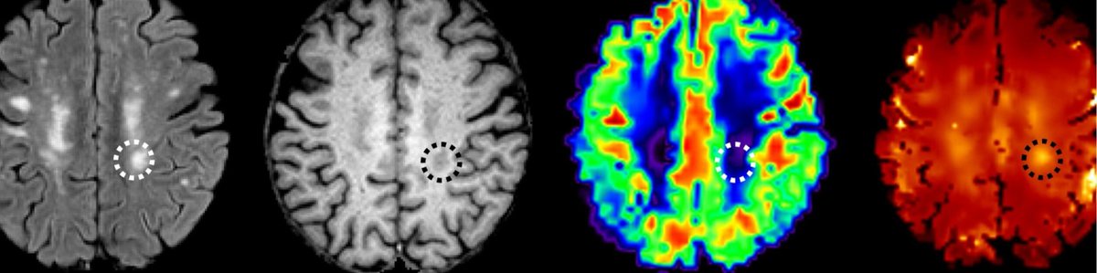 New work from our labs looking at MRI signal parameters and ischemic vulnerability in cerebral small vessel disease. What can analyses of conventional MRI sequences tell us about underlying CSVD pathophysiology? #neurology #radiology #stroke #dementia
pmc.ncbi.nlm.nih.gov/articles/PMC12…
