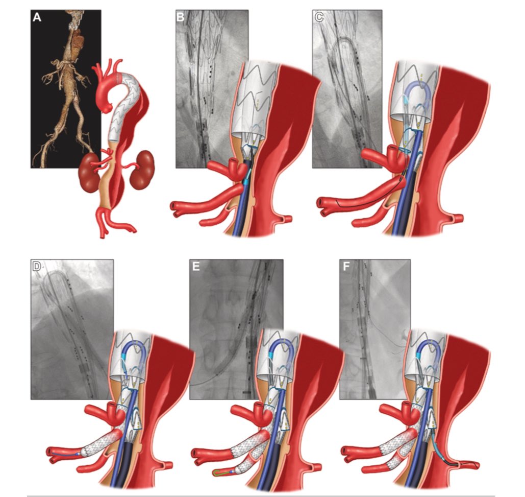 Gustavo Oderich (@gustavooderich) on Twitter photo fem-smart is a modification of what others have already described but allows staged deployment and sequential branch stenting from femoral access. Credit to Dr. Park from SP Brazil for creative process. A nice read on JVS
#FenestratedBranchAorticRepair
#GrandRounds fem-smart is a modification of what others have already described but allows staged deployment and sequential branch stenting from femoral access. Credit to Dr. Park from SP Brazil for creative process. A nice read on JVS
#FenestratedBranchAorticRepair
#GrandRounds