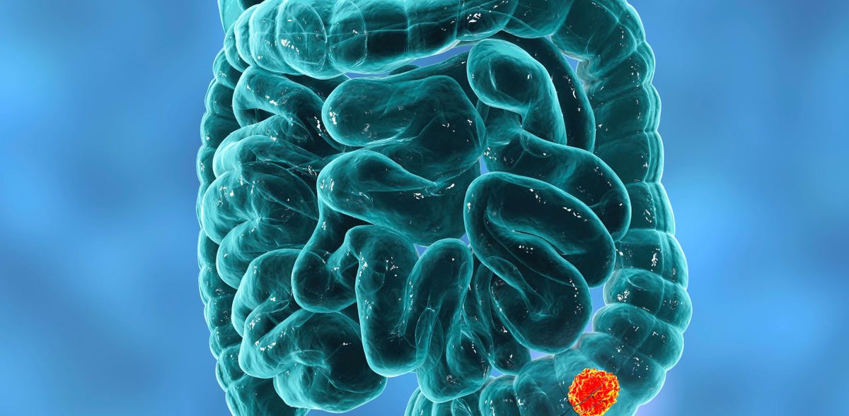 🚨 New meta-analysis: GLP-1 use linked to more than double the risk of colorectal cancer in type 2 diabetes patients.

Researchers urge caution + call for long-term trials to confirm findings.

Read more 👉 ow.ly/LPBl50WT97j
#GLP1 #Diabetes #CancerResearch