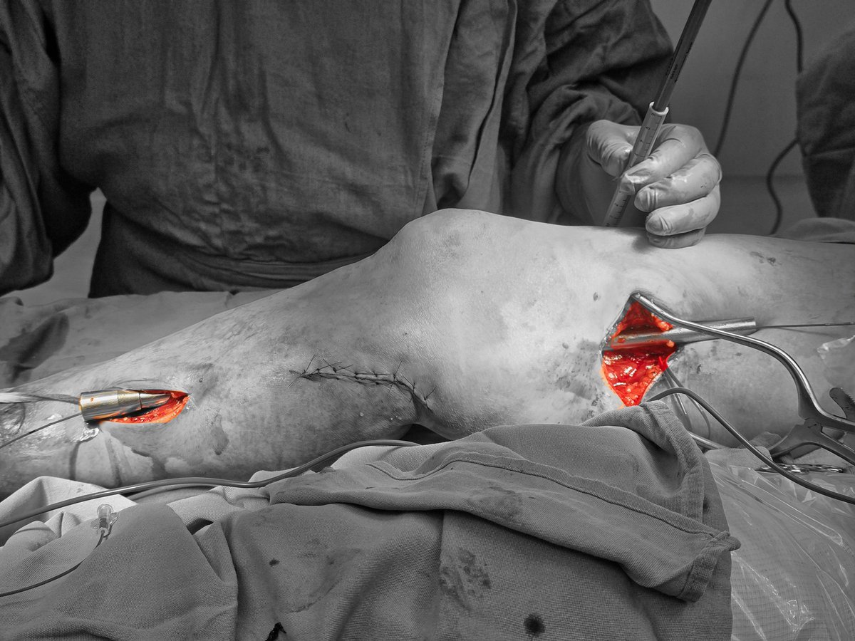 🔪🩸SFA-tibial bypass: tunneling.