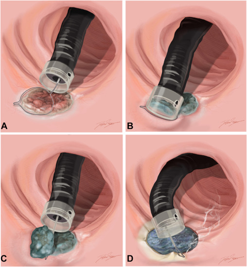 In this Review Article, Julie N. Murone et al engage in "Removing inflammatory bowel disease–associated dysplastic lesions with benign negative lift sign with cap-assisted EMR: a video tutorial for practicing gastroenterologists." videogie.org/article/S2468-…

#GITwitter