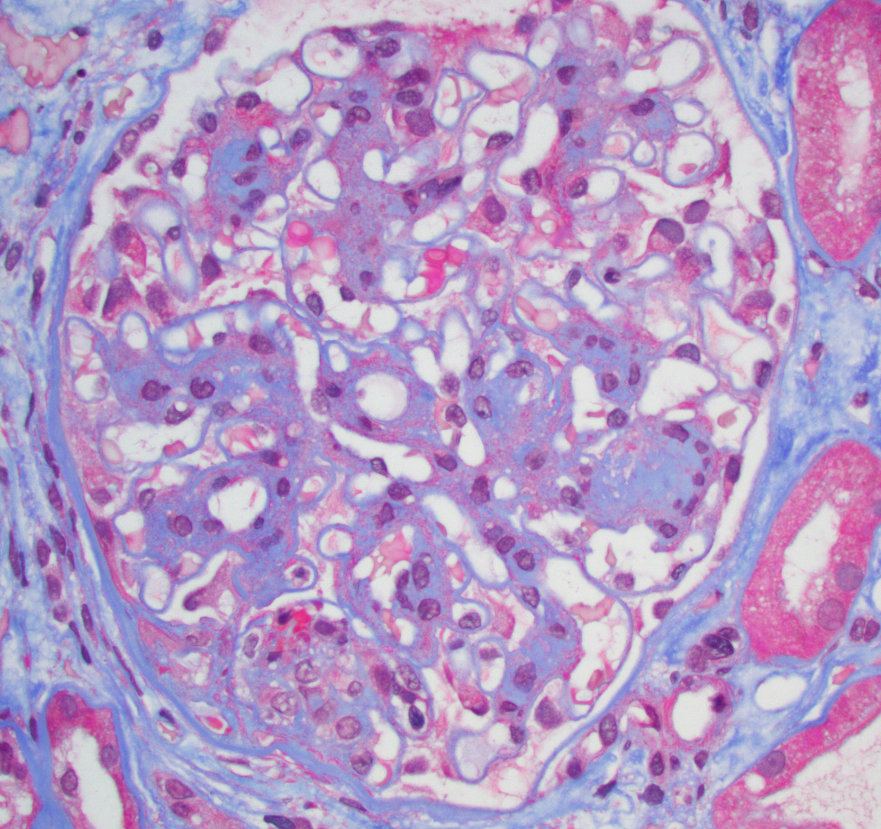 JZRenalPath's tweet photo. Multiple diagnoses not uncommon in kidney biopsies. This case showed nodular diabetic nephropathy, a mostly chronic ANCA associated GN, and to top it off some interstitial ALECT2 amyloidosis. #renalpath #nephrology #PathTwitter https://t.co/xDU95G3uPM