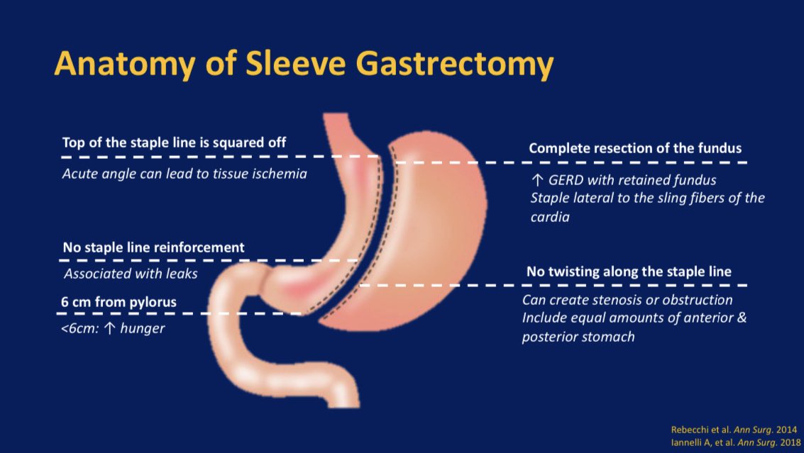 Carl Kay, MD (@carlkaymd) on Twitter photo Anatomy of Sleeve Gastrectomy
🔺 Top of staple line ➡️ ischemia
✂️ Incomplete fundus resection ➡️ GERD
❌ No staple reinforcement ➡️ leak
🔄 Twisting of staple line ➡️ stenosis
📏 >6 cm from pylorus ➡️ hunger
#GITwitter Anatomy of Sleeve Gastrectomy
🔺 Top of staple line ➡️ ischemia
✂️ Incomplete fundus resection ➡️ GERD
❌ No staple reinforcement ➡️ leak
🔄 Twisting of staple line ➡️ stenosis
📏 >6 cm from pylorus ➡️ hunger
#GITwitter
