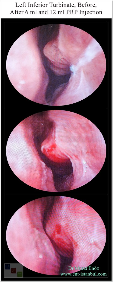 Murat Enoz, MD tweet media