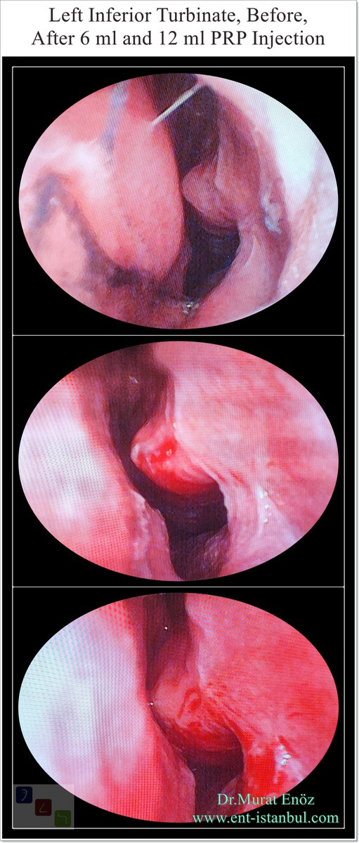 Murat Enoz, MD tweet media