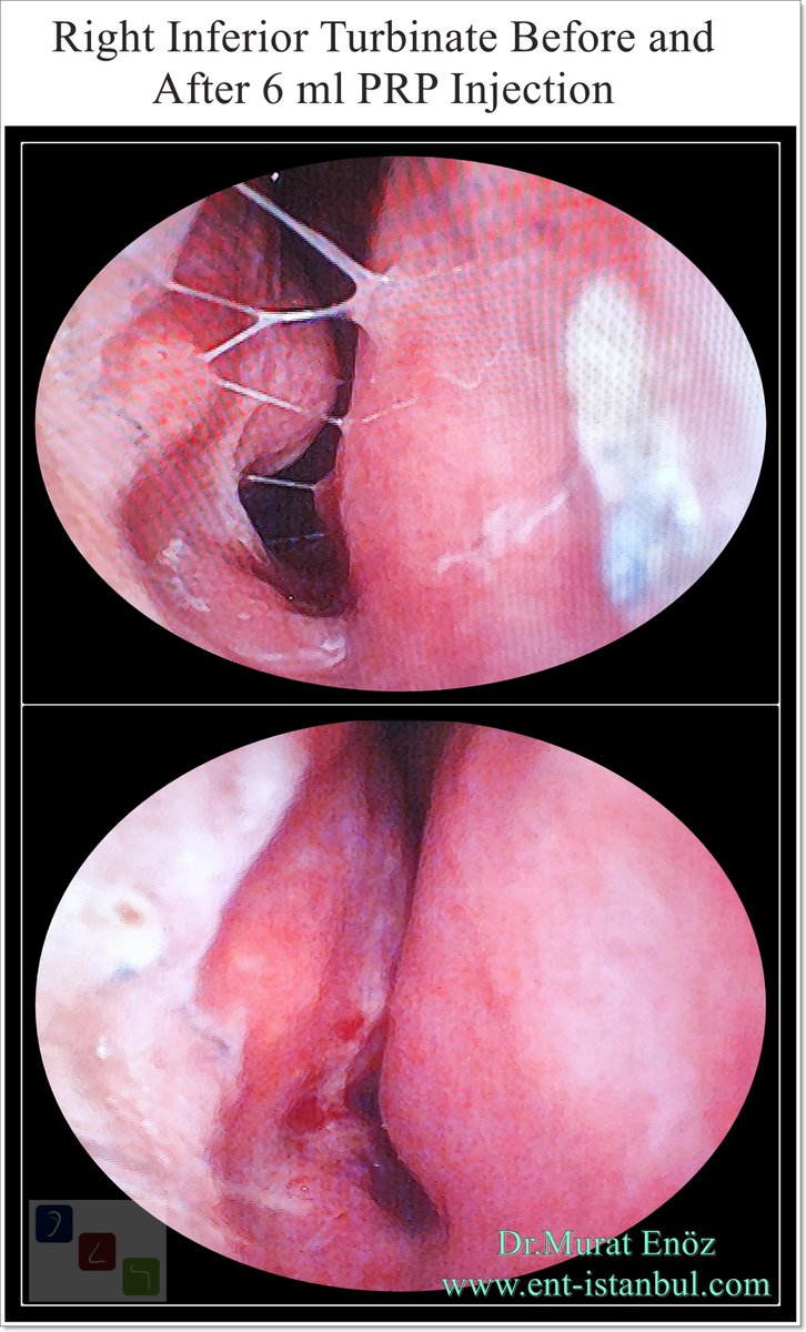 Murat Enoz, MD tweet media