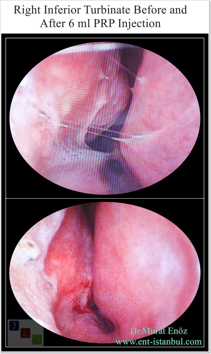 Murat Enoz, MD tweet media