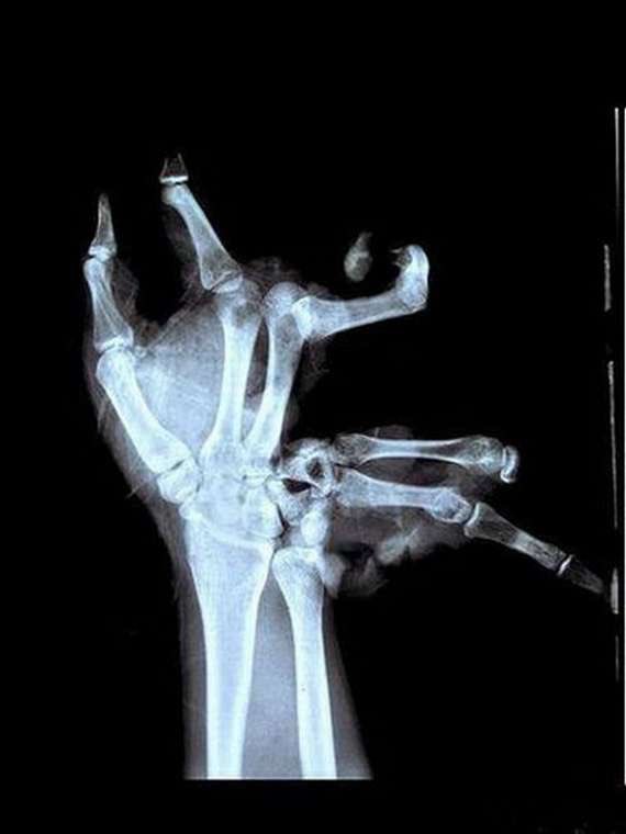 My hand after learning exactly one Yasuo BnB combo