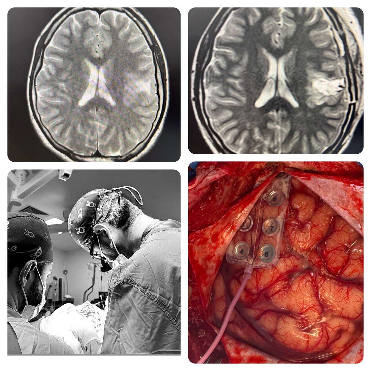 DROSCARZORRO's tweet image. Cirugía de epilepsia en área elocuente, navegación, mapeo cortical, electrocorticografia optimiza resultados y evita déficit neurológico definitivo.