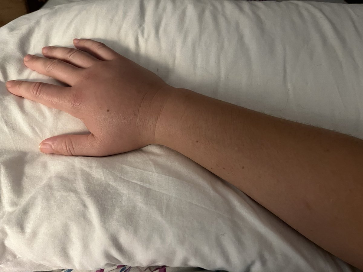 Kathrynstyan's tweet image. PSA check all your coats and jumpers that have been redundant all summer for critters. A hornet sting is not something you want to find of edge of your pocket, swelling half way up my forearm after being stung on back of my hand! #stings #hornetsting