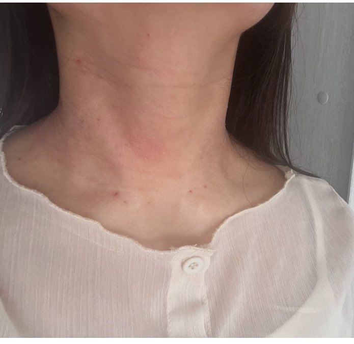 今日の首
昨日に引き続き痒い😣
疲れ溜めこみすぎてた自覚はある🥹
こんな感じの赤みと痒みが定期的にくる！だんだん出てくる頻度少なくなったり、範囲が狭まって、今年中に安定させるのが目標！！