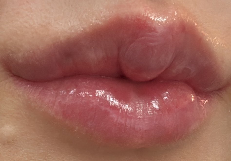 イソトレチノインのせいで乾燥しててリップでテカテカなんだけども
外側人中と口角挙上、２年経過、めちゃくちゃ良いよ👄❣️