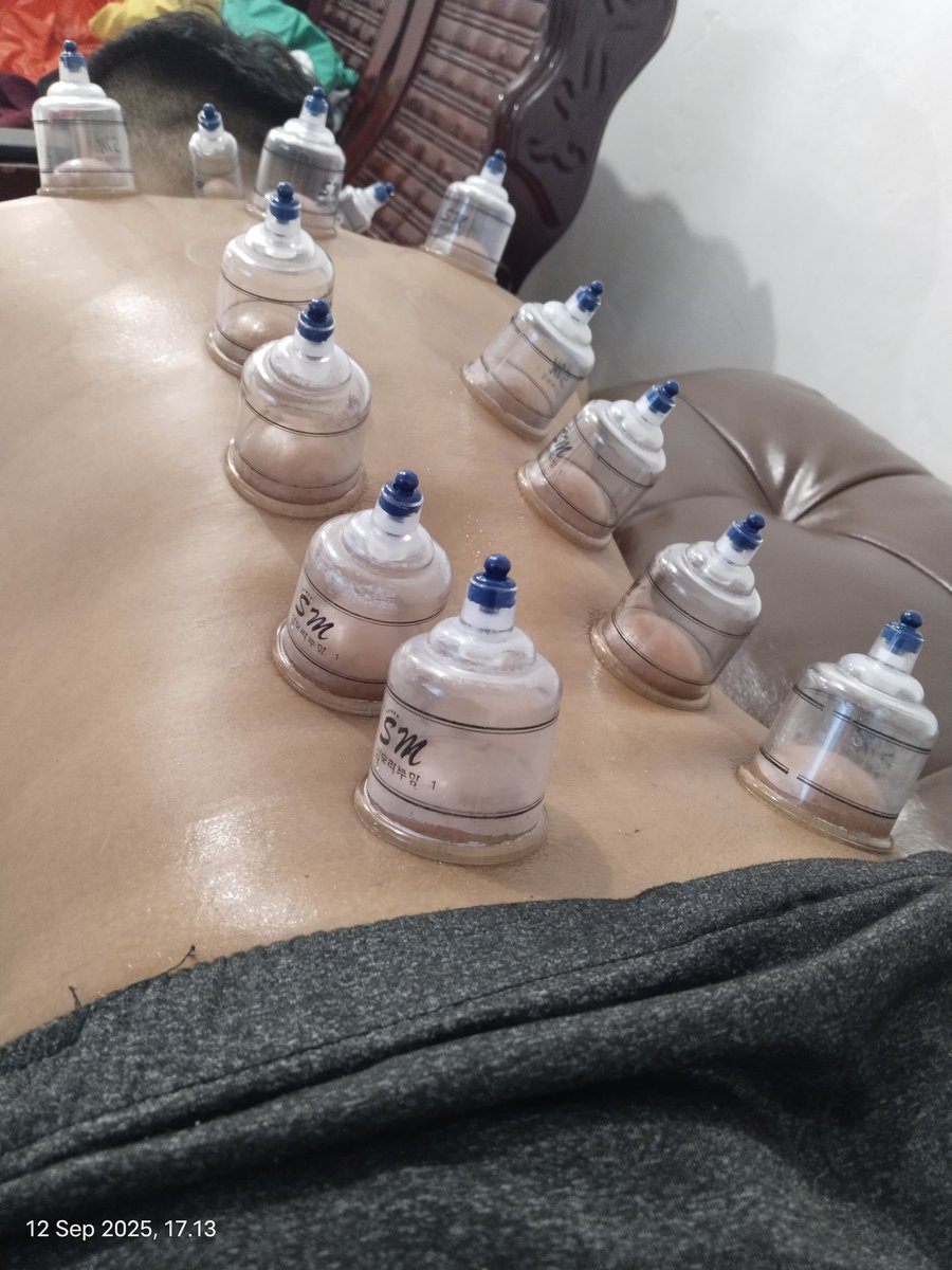 terapispku's tweet image. Diskolasi tulang pinggul dapat menyebabkan berkurang nya kualitas berhubungan suami istri. Karena kurang nya sirkulasi darah ke Mr. P dan gangguan sakit/nyeri dipinggang. Terkadang banyak menduga saraf terjepit.