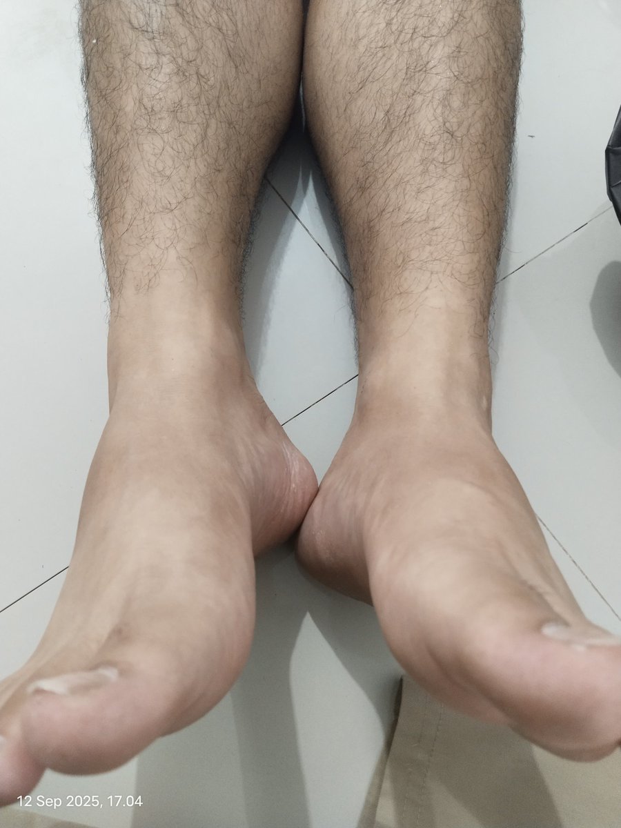 terapispku's tweet image. Diskolasi tulang pinggul dapat menyebabkan berkurang nya kualitas berhubungan suami istri. Karena kurang nya sirkulasi darah ke Mr. P dan gangguan sakit/nyeri dipinggang. Terkadang banyak menduga saraf terjepit.