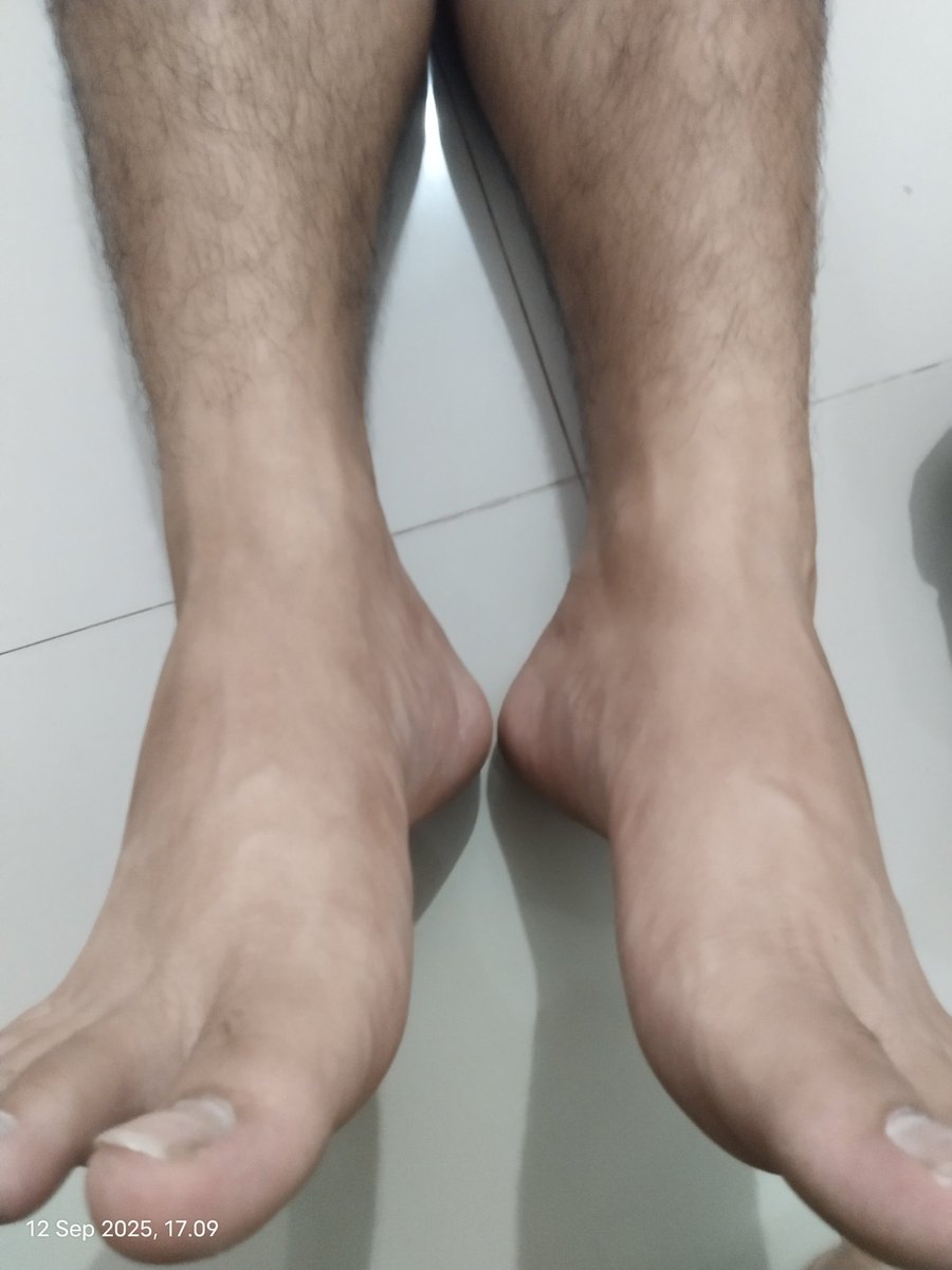 terapispku's tweet image. Diskolasi tulang pinggul dapat menyebabkan berkurang nya kualitas berhubungan suami istri. Karena kurang nya sirkulasi darah ke Mr. P dan gangguan sakit/nyeri dipinggang. Terkadang banyak menduga saraf terjepit.