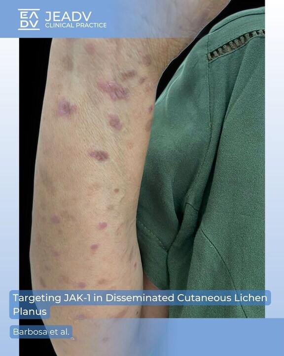 Barbosa et al. report a 63-year-old woman with severe, treatment-resistant #lichenplanus who responded to 200 mg/day #abrocitinib, a selective JAK-1 inhibitor.

#JAK inhibitors may offer a promising option, but more studies are needed.

👉 bit.ly/4fzg0V3