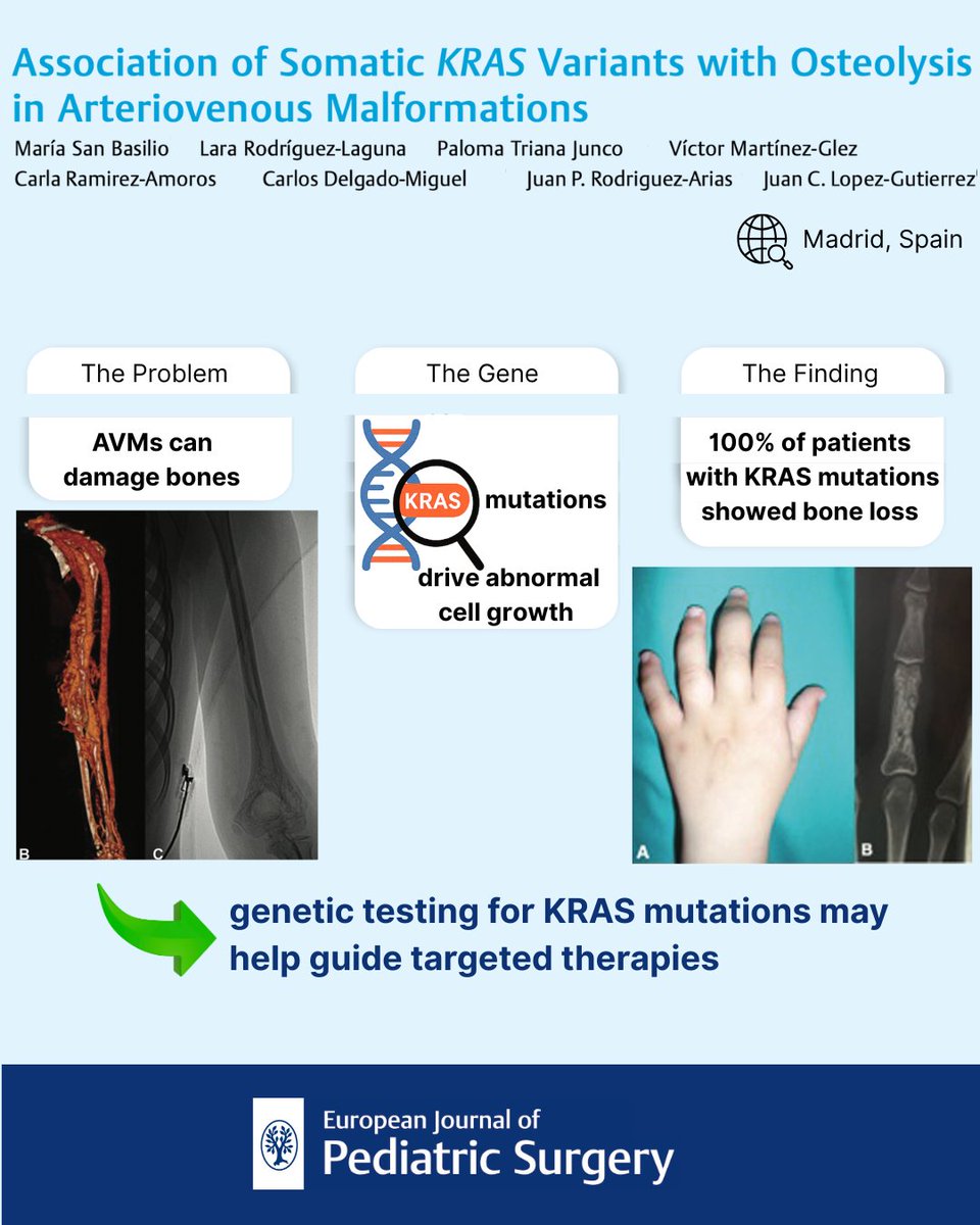 EJPS_Reports's tweet image. 🧬 In AVMs, KRAS mutation has been linked to osteolysis.
In our cohort, 100% of AVM patients with KRAS mutations showed bone loss, while none with MAP2K1, RASA1, or BRAF variants did.
Genetic testing may guide early detection &amp;amp; targeted therapy.
#AVM #KRAS #Genetics