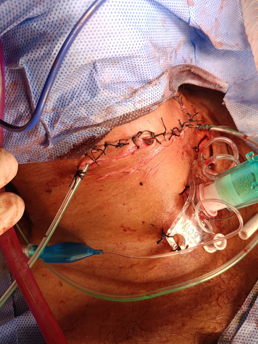 Asiritrauma1's tweet photo. [Graphic pictures]
(With Permission)
Assault 
Laryngeal thyro-hyoid separation
We intubated through Hole
In OR-formal Tracheotomy
Repair of Larynx(including detached epiglottis)
+Strap muscles 
+Hemostasis
Voice is ok
Decannulated in 1 wk✅
Discharged in 10 days✅
#NeckTrauma https://t.co/xnPtHZjgql
