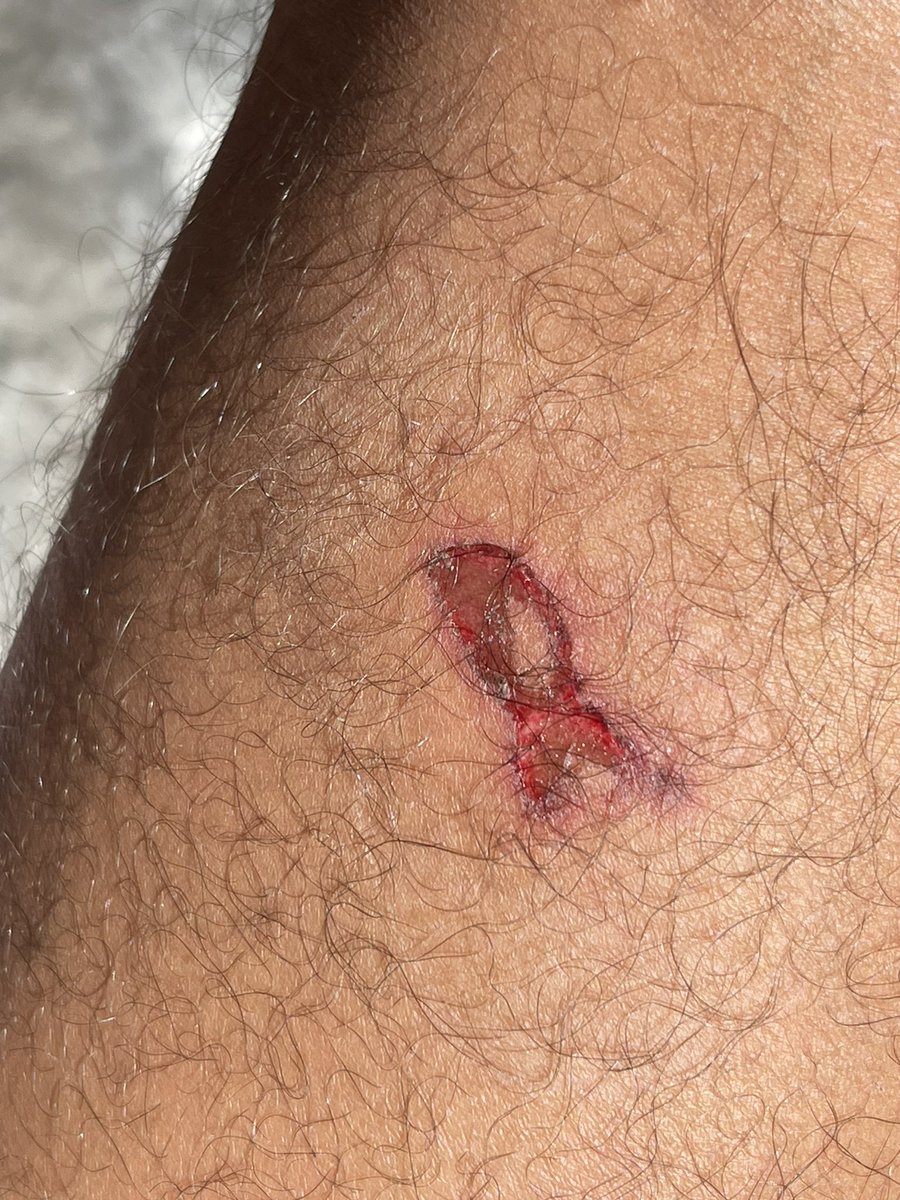 Le #10septembre, j’ai été touché par une grenade de désencerclement alors que je couvrais pour <a href="/blast_france/">BLAST, Le souffle de l'info</a> à Paris. Heureusement, je n’en garde pas de séquelles plus graves, même si la douleur est bien réelle 😅

Merci à <a href="/GaspardGlanz/">Gaspard Glanz</a> pour ton aide précieuse !