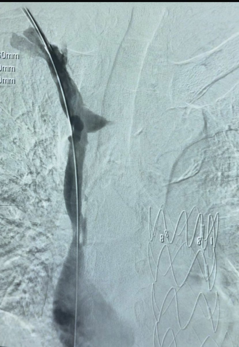 abeerfd's tweet image. مريض يعاني من انسداد كامل في الوريد الأجوف العلوي.
 بالأشعة التداخلية أُعيد فتح الوريد وتدفق الدم من جديد، غالبًا بسبب قساطر قديمة.
حياة أفضل للمريض