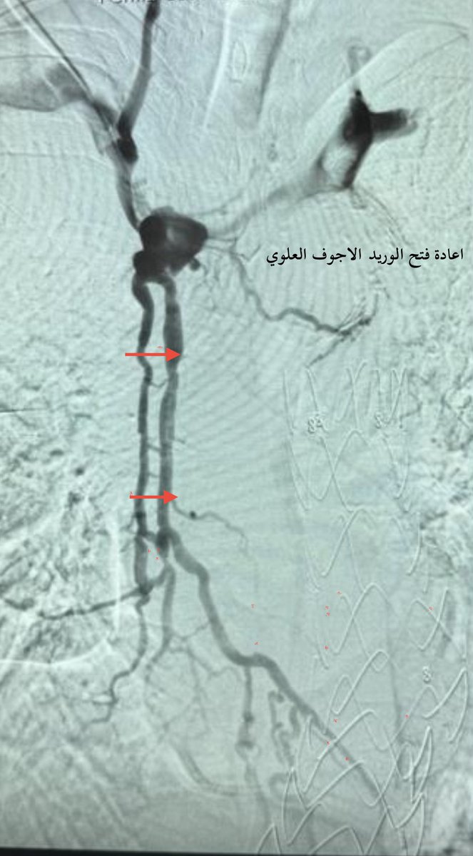 abeerfd's tweet image. مريض يعاني من انسداد كامل في الوريد الأجوف العلوي.
 بالأشعة التداخلية أُعيد فتح الوريد وتدفق الدم من جديد، غالبًا بسبب قساطر قديمة.
حياة أفضل للمريض