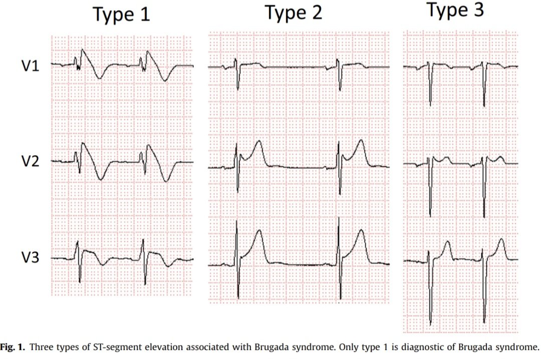 javier20ch's tweet photo. Síndromes de Onda J. 🫀⚡️
🔶️La aparición de ondas J prominente en el EKG se ha descrito desde hace tiempo en casos de hipotermia y la hipercalcemia. Sin embargo, mas recientemente, la acentuación de la onda J se ha asociado con arritmias ventriculares potencialmente mortales. ⚠️🧐
🔶️Los Sx de onda J consisten en el Síndrome de Brugada y el Síndrome de Repolarización Precoz. 
🔶️La onda J en el EKG se manifiesta por un desnivel de voltaje transmural, atribuible a una muesca del potencial de acción mas pronunciada en el epicardio que en el endocardio.
🔶️Presentación clínica variable, desde patrón EKG asintomáticos hasta síncope, TV/FV, muerte súbita☠️🫀. Importante identificar riesgo alto/bajo [criterios diagnósticos de Shangai].
🔶️Tratamiento: vigilancia, farmacológico [Quinidina💊], DAI, Ablación ⚡️💥.

📚🆓️⤵️
https://t.co/aS1B2Np92y
https://t.co/AnTPYsIWMG