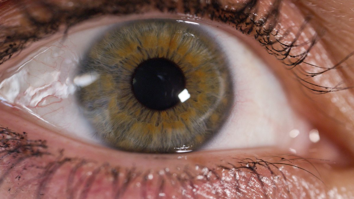 opto_advisor's tweet image. Patient-reported #VisualFunction and #Dysphotopsia outcomes of extended focus #IntraocularLenses (IOLs) can vary depending on preoperative ocular characteristics such as #PupilSize, #AxialLength, and #CornealIrregularities. Study in @ActaOphthalmol

Read here:…