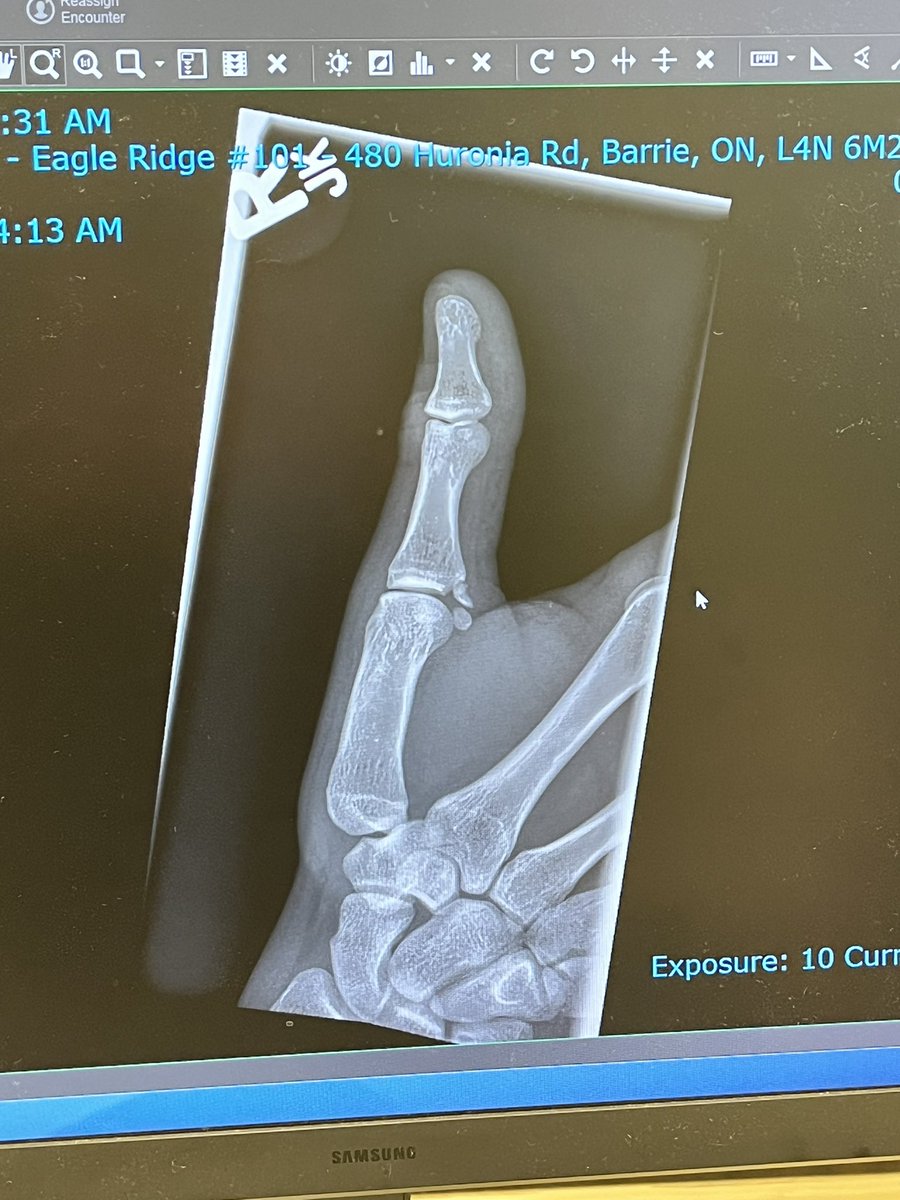 Kositv_'s tweet photo. No video games for a little broke my thumb https://t.co/Svk6nUZpdC