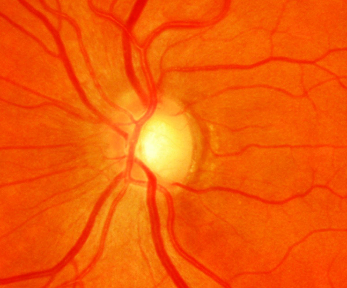 revoptom's tweet image. Study Finds Common Allergens Associated with Risk of Glaucoma

House dust mites were among the most sensitive. Researchers speculate on a mechanism of chronic low-grade systemic inflammation.

Read more:
reviewofoptometry.com/article/study-…

#optometry #eyecare #allergies #glaucoma