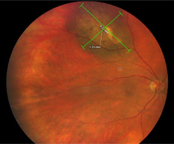 revoptom's tweet image. L-Lactate Levels in Aqueous Humor Higher in those with Uveal Melanoma

Researchers suggest this could be a promising biomarker to aid in early diagnosis of this highly fatal disease.

Read more:
reviewofoptometry.com/article/llacta…

#optometry #optometrist #eyecare #uvealmelanoma