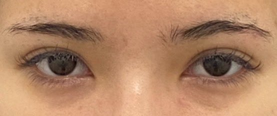 涙袋のヒアルロン酸施術を受けました。美容医療自体が初めてでとても緊張していましたが、院長先生が本当に優しく落ち着いた雰囲気で声をかけてくださったので安心することができました。スタッフの方々も笑顔で迎えてくれて対応が丁寧でした。また伺いたいです。
#フルリュン美容外科　#韓国整形