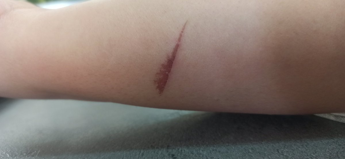 Georgiangirl76's tweet photo. #فکت 
همه دخترا یه جای سوختگی اینجوری دارن رو دستاشون🤦🏽‍♀️😂 https://t.co/tX9UISzcFn