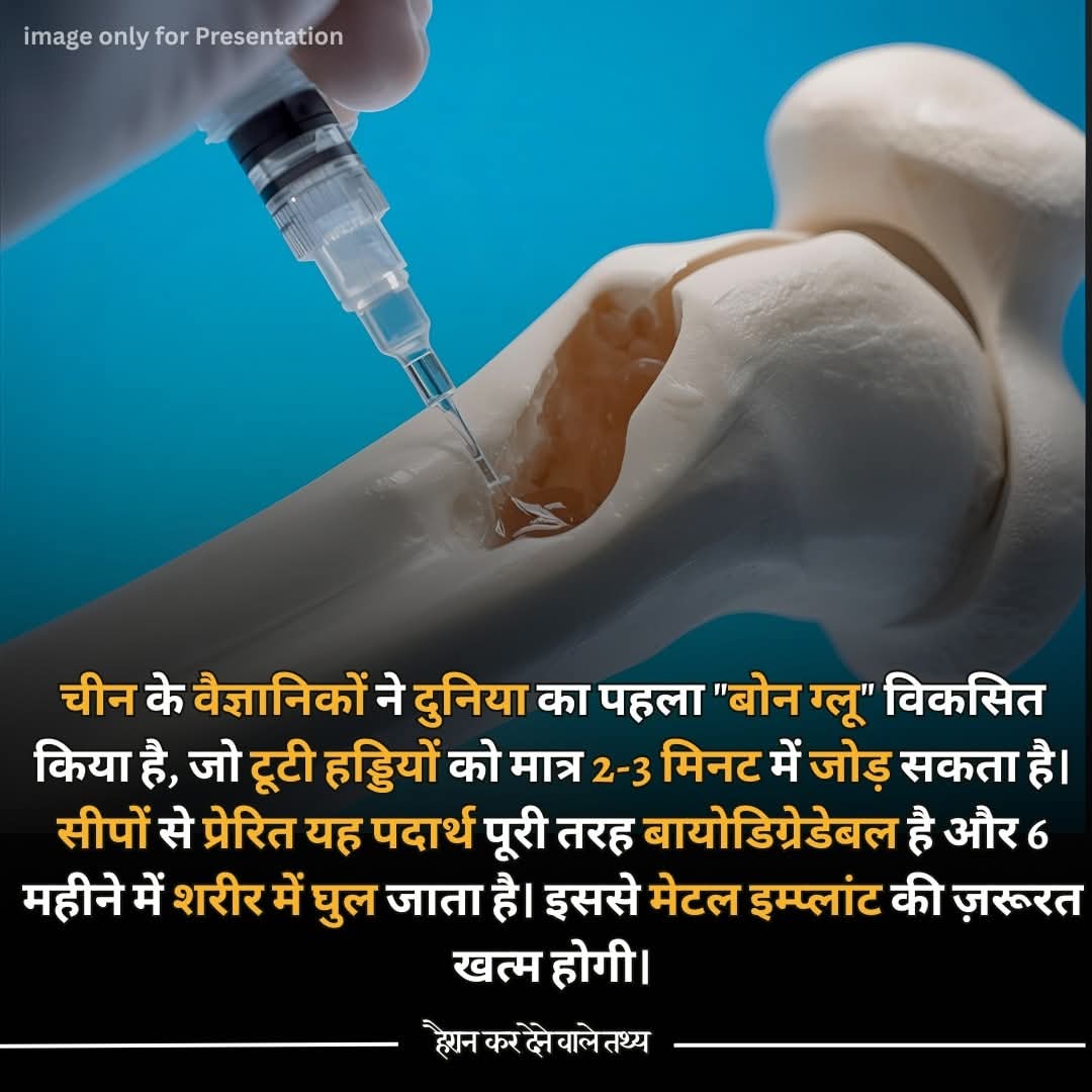MrkBrother_007's tweet image. अब हड्डी तोड़ने में और हड्डी तुड़वाने में दिक्कत नहीं होगी 🤭
#चीन के वैज्ञानिकों ने बनाया दुनिया का पहला #BoneGlue 🦴 जो टूटी हड्डियों को 2-3 मिनट में जोड़ देता है। 🌊 सीपों से प्रेरित यह पूरी तरह #Biodegradable है और 6 महीने में शरीर में घुल जाता है। 🚑✨