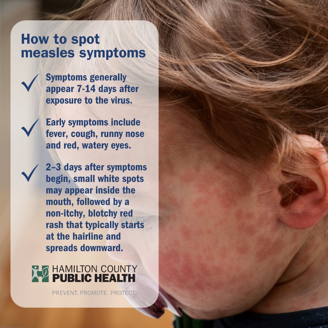 #Measles is highly contagious! 🤒 Spotting symptoms early helps protect your family &amp; community.

🌡️ Fever, cough, runny nose, red eyes
🔴 Rash starts at hairline, usually not itchy
🕒 Symptoms show 7–14 days after exposure

More info 👉 bit.ly/3Vdebny