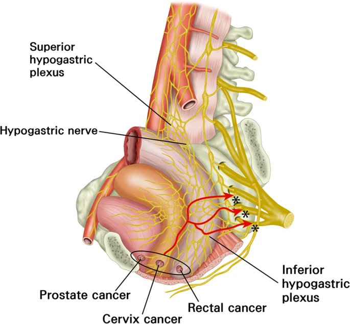 Has2s's tweet image. Precision is key in pain management. ✨

For patients suffering from chronic, intractable pain in the perineum region, a CT-guided inferior hypogastric plexus block
During a recent case, we achieved a perfect distribution of contrast 🎯 
#Pain #Interventional_Radiology #Radiology