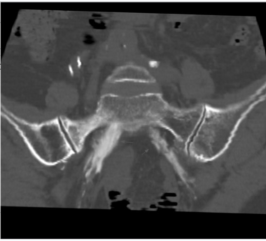 Has2s's tweet image. الأشعة التداخلية توفر أحد الحلول المتقدمة لعلاج الالام المزمنة والمستعصية في منطقة العجان من خلال علاج الأعصاب الموصلة لها عن طريق توجيه الأشعة 
🎯 #الألم #الأشعة_التداخلية #الأشعة #أعصاب