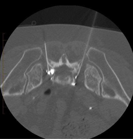 Has2s's tweet image. الأشعة التداخلية توفر أحد الحلول المتقدمة لعلاج الالام المزمنة والمستعصية في منطقة العجان من خلال علاج الأعصاب الموصلة لها عن طريق توجيه الأشعة 
🎯 #الألم #الأشعة_التداخلية #الأشعة #أعصاب